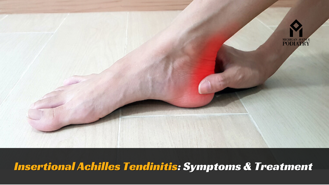 Read more about the article Insertional Achilles Tendinitis: Symptoms & Treatment