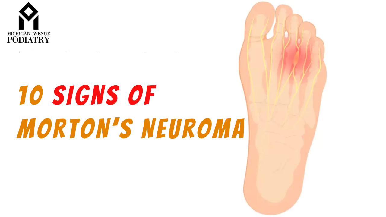 Read more about the article 10 Signs You May Have Morton’s Neuroma