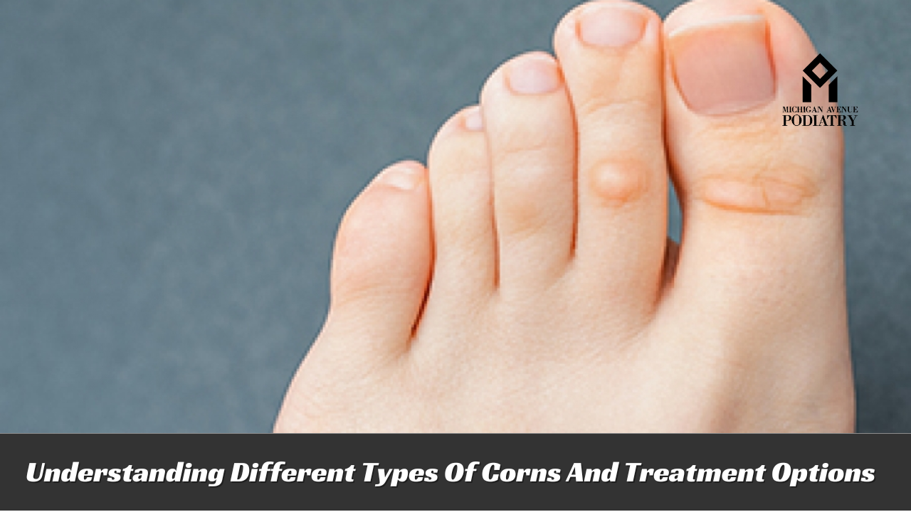 You are currently viewing Understanding Different Types Of Corns And Treatment Options
