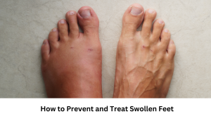 Read more about the article How to Prevent and Treat Swollen Feet: Causes and Solutions