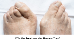 Read more about the article What Are the Most Effective Treatments for Hammer Toes?