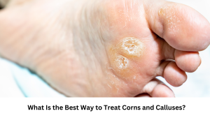 Read more about the article What Is the Best Way to Treat Corns and Calluses? Effective Methods Explained