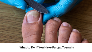 Read more about the article What to Do If You Have Fungal Toenails: Treatment Options and Prevention