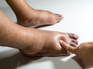 Read more about the article Why Regular Foot Check-Ups are Crucial for Diabetic Patients in Chicago