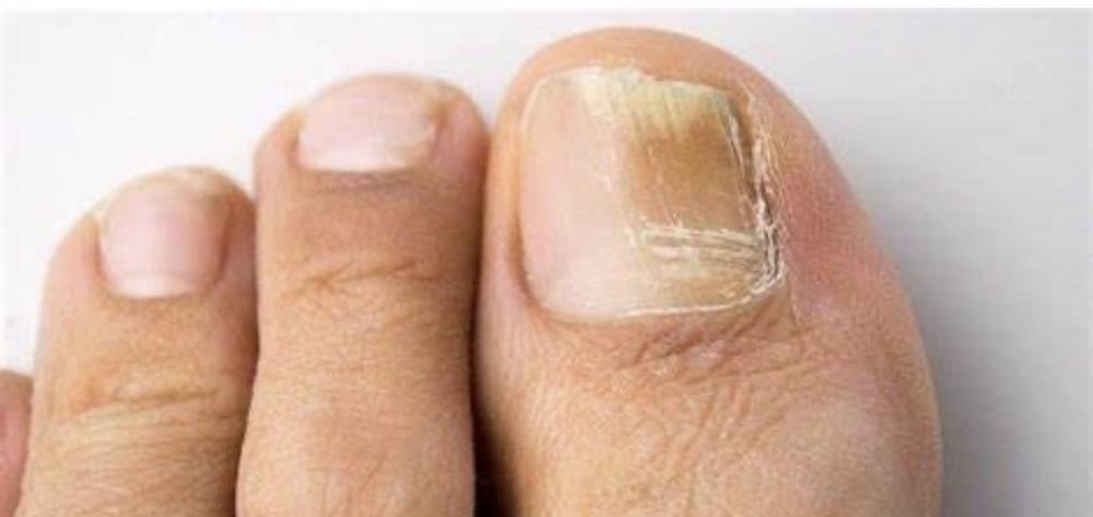 Read more about the article Fungal Nails: Treatment Options from Chicago Podiatrists