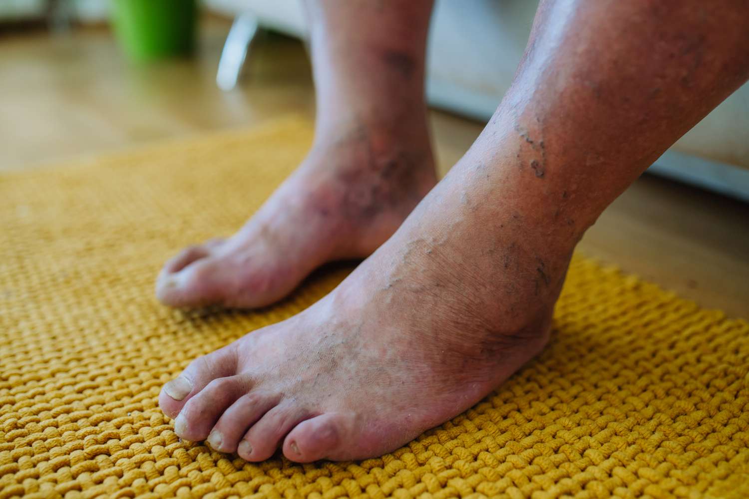 Read more about the article Diabetic Foot Care: Signs You Need to See a Chicago Foot Doctor