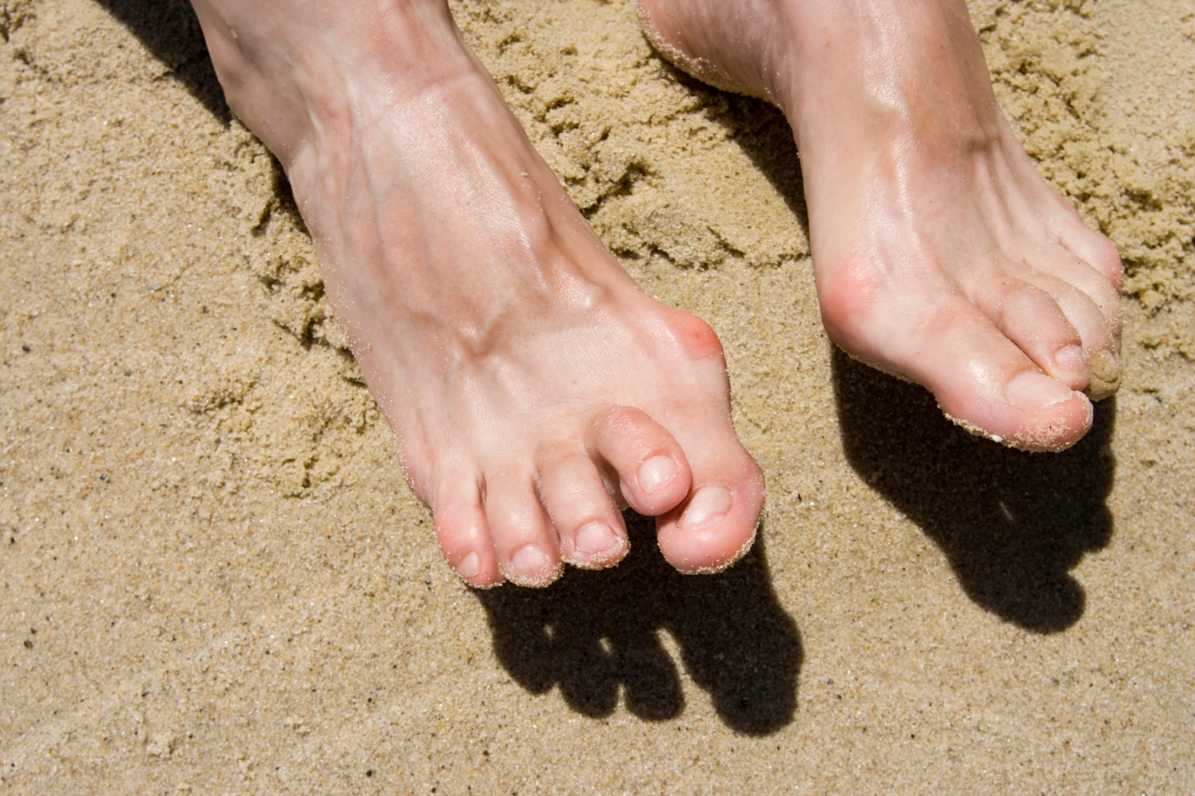 You are currently viewing Understanding Hammer Toes: Care Tips from Chicago Podiatrists