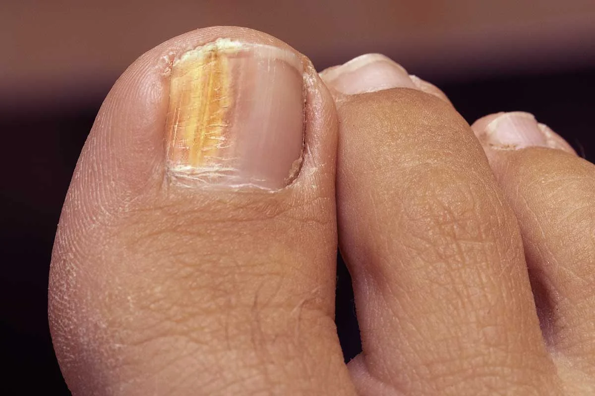 Read more about the article Signs You Have Fungal Nails: A Chicago Podiatrist’s Perspective