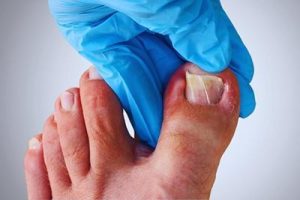 Read more about the article Understanding Ingrown Toenails: Care Tips from Chicago Podiatrists