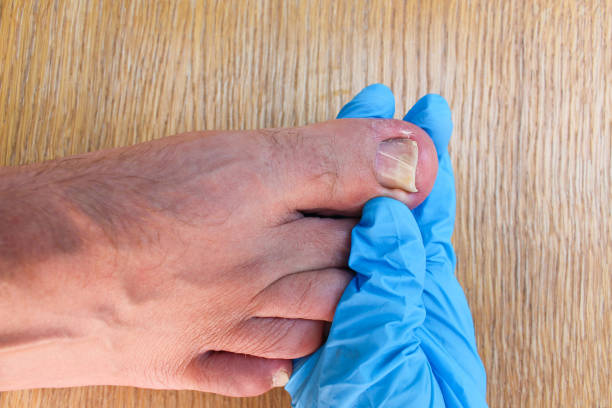 You are currently viewing Treatment Options for Ingrown Toe Nails: Chicago Foot Doctors