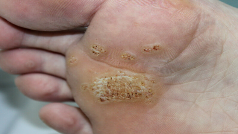 Symptoms Of Plantar Warts: When To Seek Help From Chicago Specialists ...