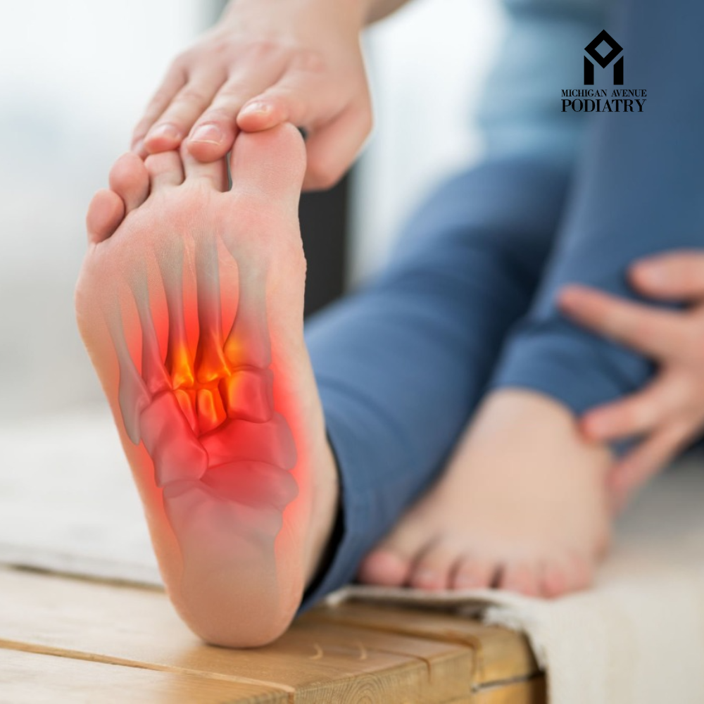 Plantar fasciitis treatment Chicago &mdash; heel pain diagram showing inflamed plantar fascia