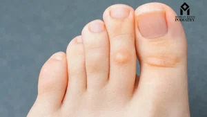 Read more about the article How to Remove Foot Corn and Calluses at Home