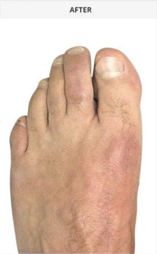 After minimally invasive bunion surgery with corrected toe alignment - Michigan Avenue Podiatry Chicago IL