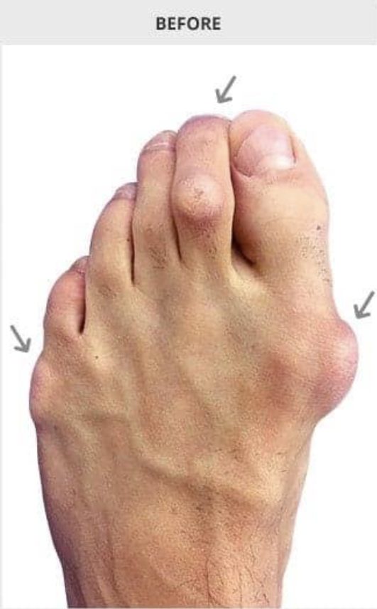Before bunion surgery showing hallux valgus deformity - Michigan Avenue Podiatry Chicago IL