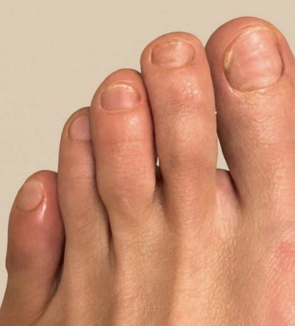 After laser fungal nail therapy with clear healthy toenails - Michigan Avenue Podiatry Chicago IL