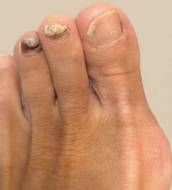 Before laser fungal nail treatment showing onychomycosis - Michigan Avenue Podiatry Chicago IL