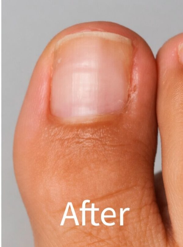 After ingrown toenail removal with healthy nail restored - Michigan Avenue Podiatry Chicago IL