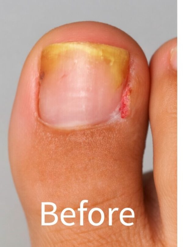 Before ingrown toenail removal showing inflamed painful nail - Michigan Avenue Podiatry Chicago IL