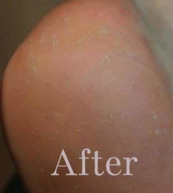 After medical pedicure with smooth healthy heel restored - Michigan Avenue Podiatry Chicago IL