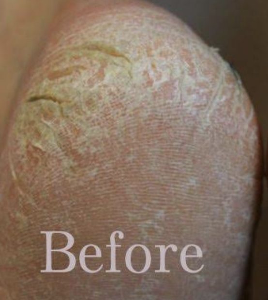 Before medical pedicure showing cracked dry callused heel - Michigan Avenue Podiatry Chicago IL